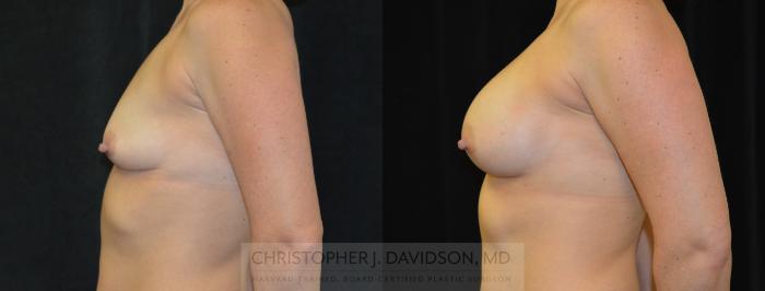 Breast Augmentation Case 267 Before & After Right Side | Boston, MA | Christopher J. Davidson, MD
