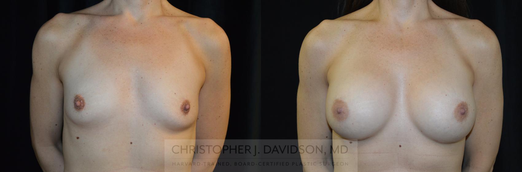 Breast Augmentation Case 275 Before & After Front | Boston, MA | Christopher J. Davidson, MD