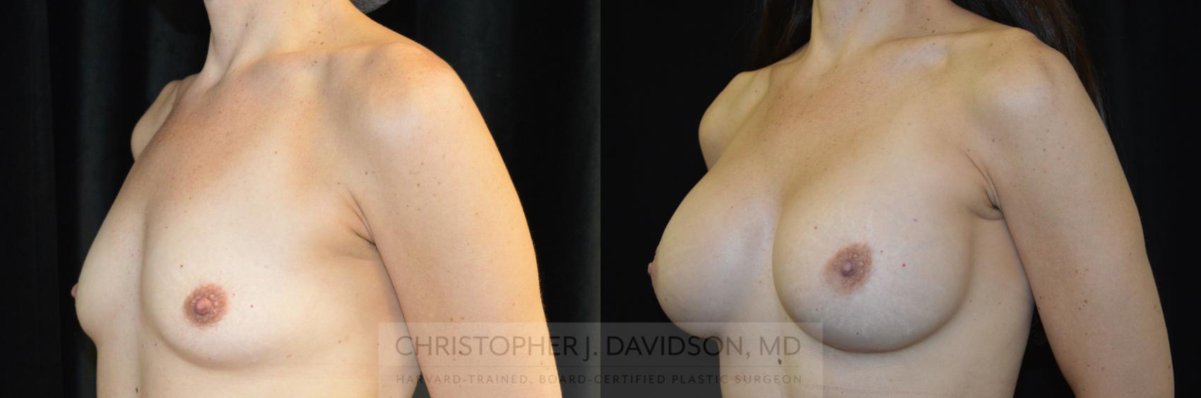 Breast Augmentation Case 275 Before & After Left Oblique | Wellesley, MA | Christopher J. Davidson, MD