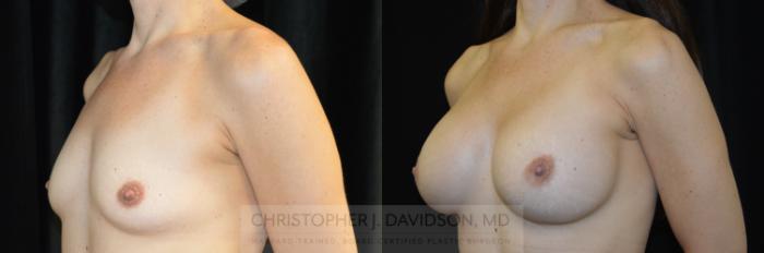 Breast Augmentation Case 275 Before & After Left Oblique | Boston, MA | Christopher J. Davidson, MD