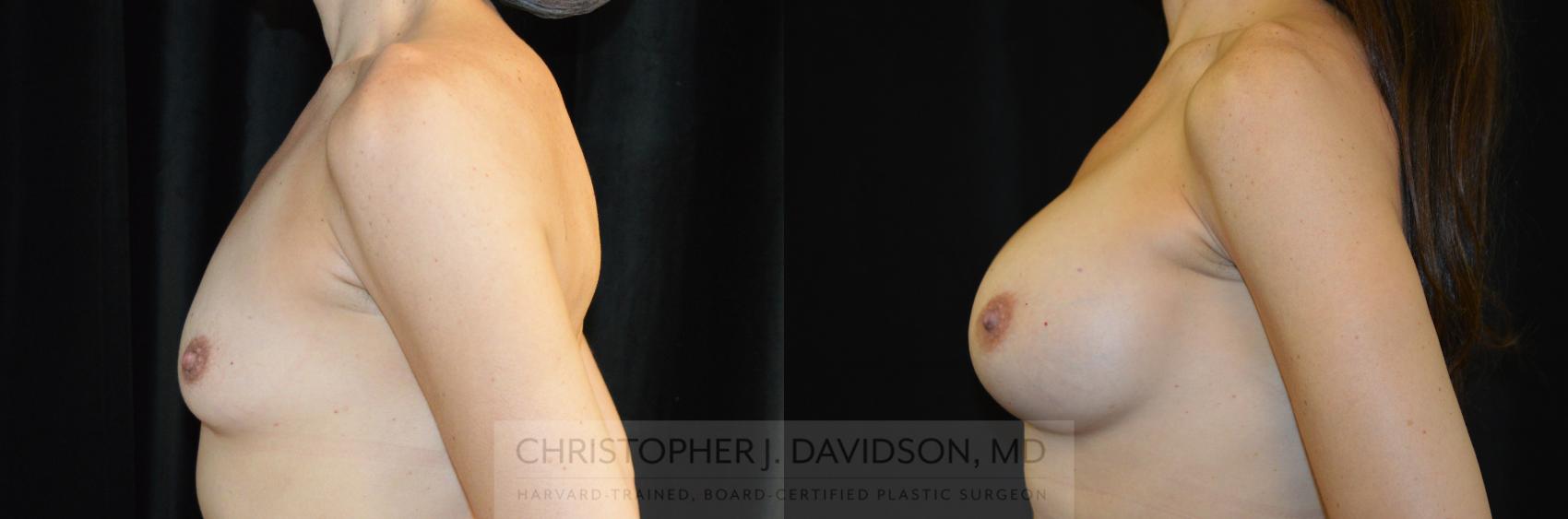 Breast Augmentation Case 275 Before & After Left Side | Wellesley, MA | Christopher J. Davidson, MD