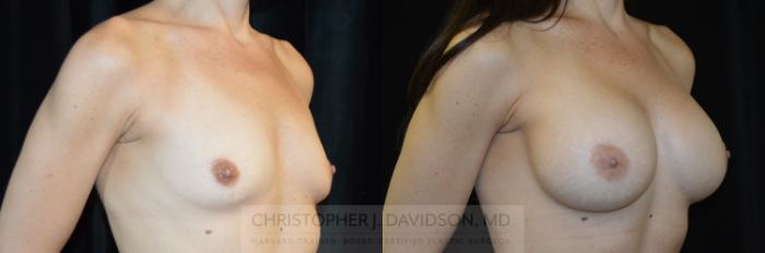 Breast Augmentation Case 275 Before & After Right Oblique | Boston, MA | Christopher J. Davidson, MD