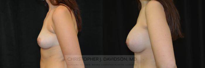 Breast Augmentation Case 277 Before & After Left Side | Wellesley, MA | Christopher J. Davidson, MD
