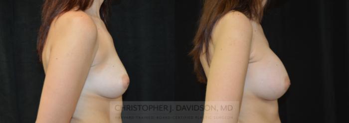 Breast Augmentation Case 277 Before & After Right Side | Wellesley, MA | Christopher J. Davidson, MD