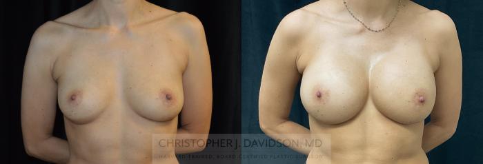 Breast Augmentation Case 278 Before & After Front | Boston, MA | Christopher J. Davidson, MD