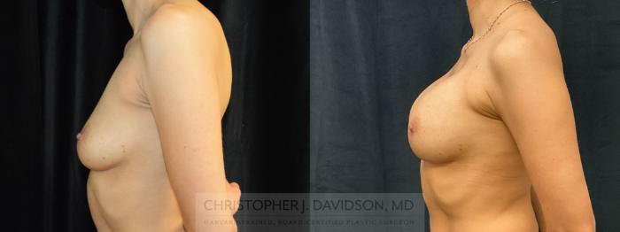 Breast Augmentation Case 278 Before & After Left Side | Boston, MA | Christopher J. Davidson, MD