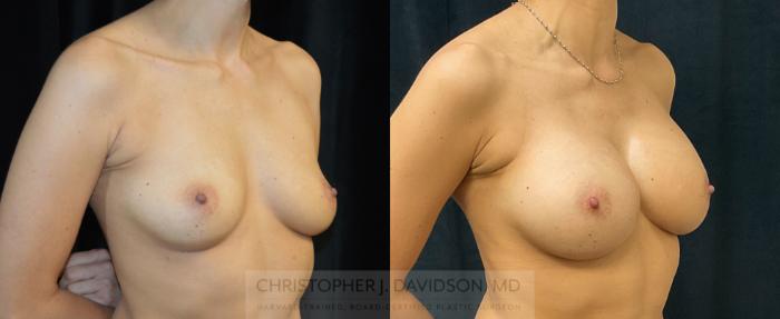 Breast Augmentation Case 278 Before & After Right Oblique | Boston, MA | Christopher J. Davidson, MD