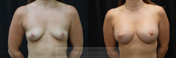 Breast Augmentation Case 279 Before & After Front | Boston, MA | Christopher J. Davidson, MD