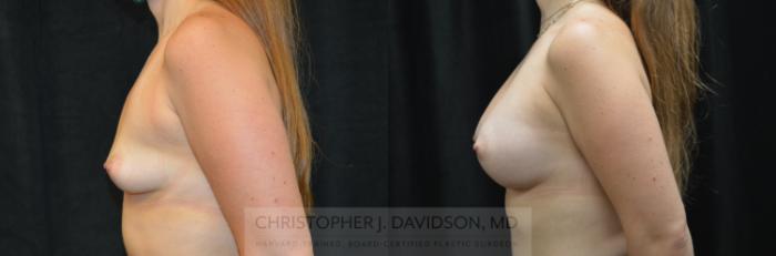 Breast Augmentation Case 279 Before & After Left Side | Boston, MA | Christopher J. Davidson, MD