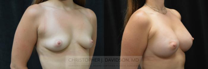 Breast Augmentation Case 279 Before & After Right Oblique | Boston, MA | Christopher J. Davidson, MD