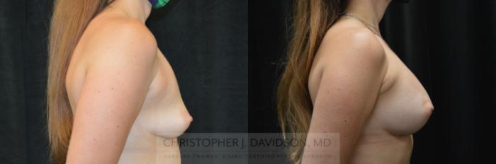 Breast Augmentation Case 279 Before & After Right Side | Boston, MA | Christopher J. Davidson, MD