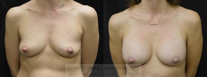 Breast Augmentation Case 28 Before & After View #1 | Boston, MA | Christopher J. Davidson, MD
