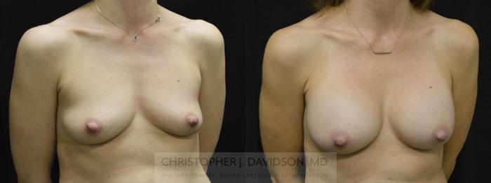 Breast Augmentation Case 28 Before & After View #2 | Boston, MA | Christopher J. Davidson, MD