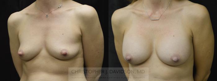 Breast Augmentation Case 28 Before & After View #3 | Boston, MA | Christopher J. Davidson, MD