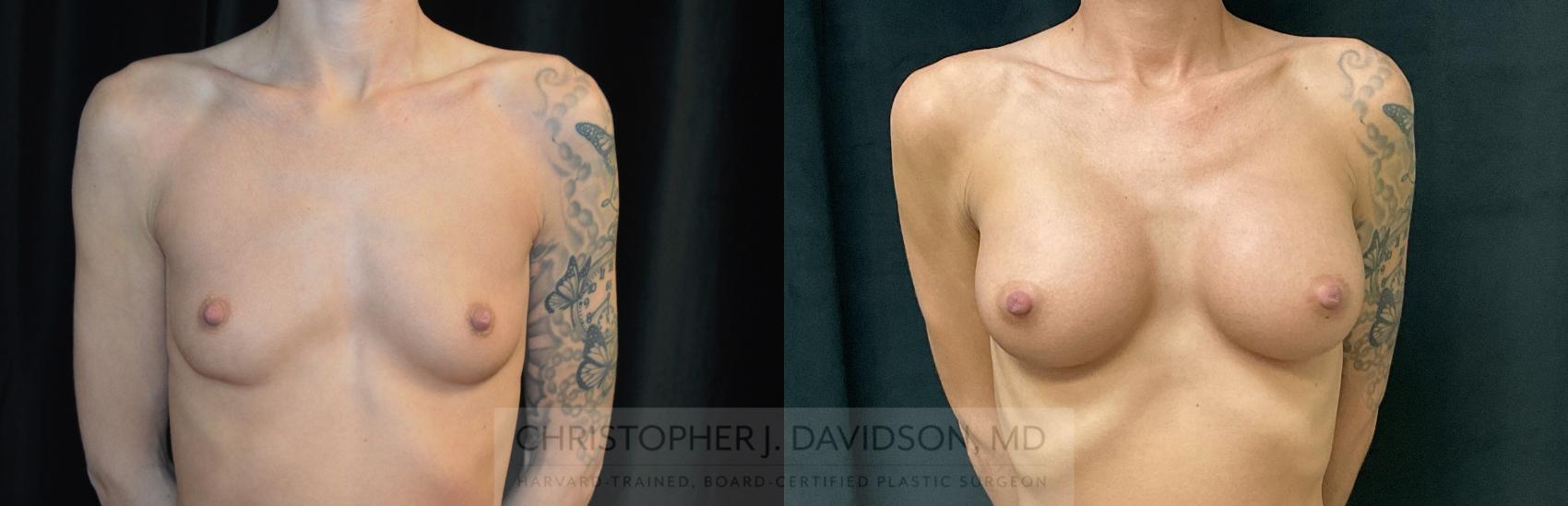 Breast Augmentation Case 282 Before & After Front | Boston, MA | Christopher J. Davidson, MD