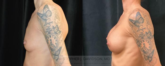 Breast Augmentation Case 282 Before & After Left Side | Boston, MA | Christopher J. Davidson, MD