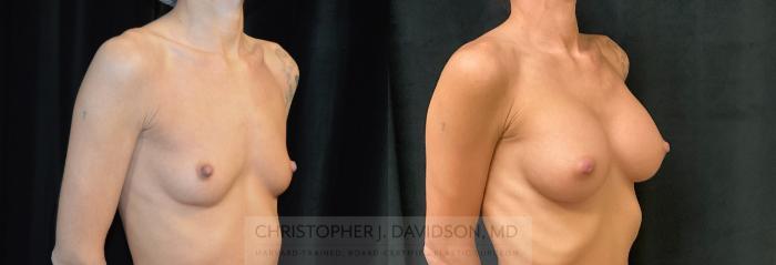 Breast Augmentation Case 282 Before & After Right Oblique | Boston, MA | Christopher J. Davidson, MD