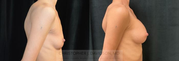Breast Augmentation Case 282 Before & After Right Side | Boston, MA | Christopher J. Davidson, MD