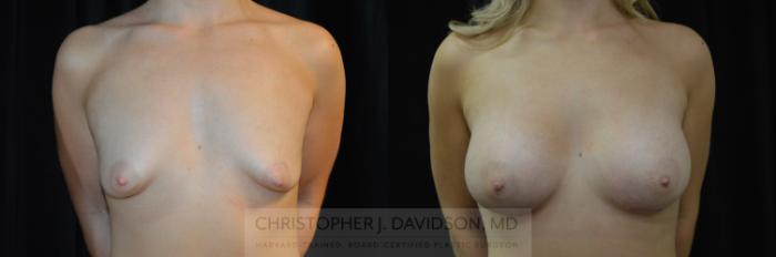 Breast Augmentation Case 285 Before & After Front | Boston, MA | Christopher J. Davidson, MD