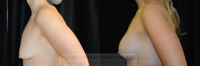 Breast Augmentation Case 285 Before & After Left Side | Boston, MA | Christopher J. Davidson, MD