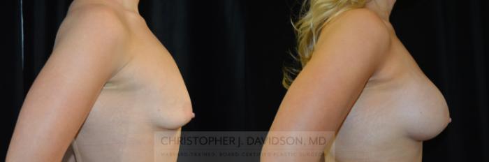 Breast Augmentation Case 285 Before & After Right Side | Boston, MA | Christopher J. Davidson, MD
