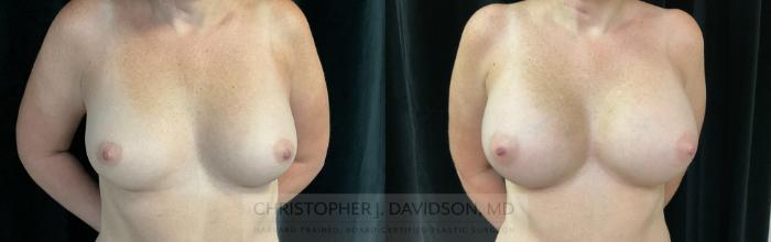 Breast Augmentation Case 286 Before & After Front | Boston, MA | Christopher J. Davidson, MD