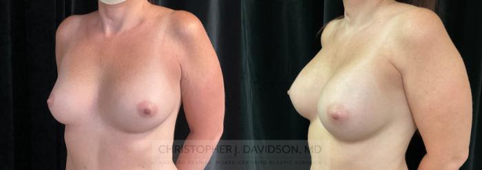 Breast Augmentation Case 286 Before & After Left Oblique | Boston, MA | Christopher J. Davidson, MD