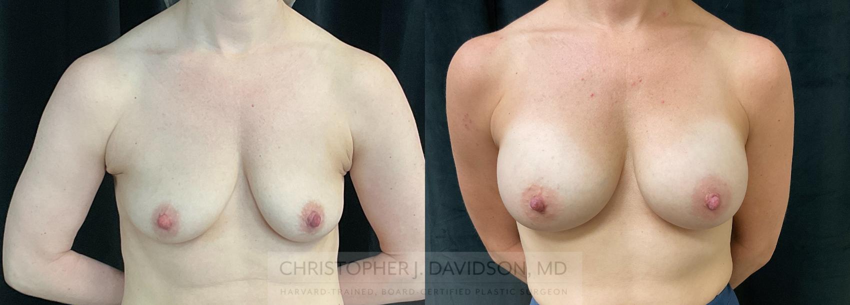 Breast Augmentation Case 289 Before & After Front | Boston, MA | Christopher J. Davidson, MD