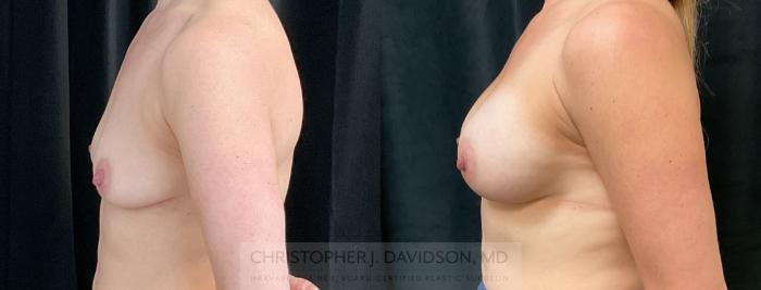 Breast Augmentation Case 289 Before & After Left Side | Boston, MA | Christopher J. Davidson, MD