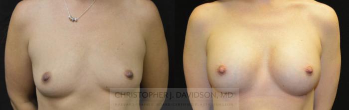 Breast Augmentation Case 29 Before & After View #1 | Boston, MA | Christopher J. Davidson, MD