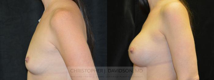 Breast Augmentation Case 29 Before & After View #2 | Boston, MA | Christopher J. Davidson, MD