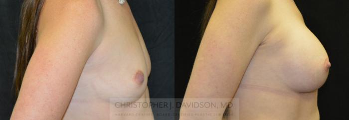 Breast Augmentation Case 29 Before & After View #3 | Boston, MA | Christopher J. Davidson, MD