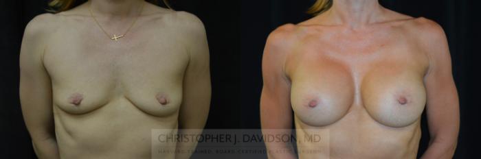 Breast Augmentation Case 291 Before & After Front | Boston, MA | Christopher J. Davidson, MD