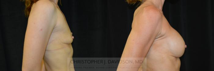 Breast Augmentation Case 291 Before & After Right Side | Boston, MA | Christopher J. Davidson, MD