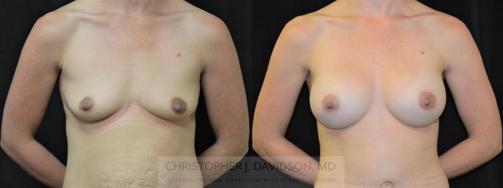 Breast Augmentation Case 293 Before & After Front | Boston, MA | Christopher J. Davidson, MD