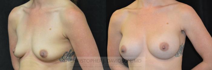 Breast Augmentation Case 293 Before & After Left Oblique | Boston, MA | Christopher J. Davidson, MD