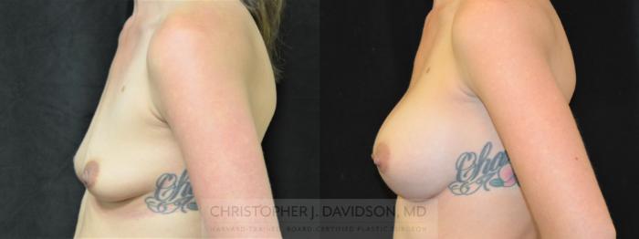 Breast Augmentation Case 293 Before & After Left Side | Boston, MA | Christopher J. Davidson, MD