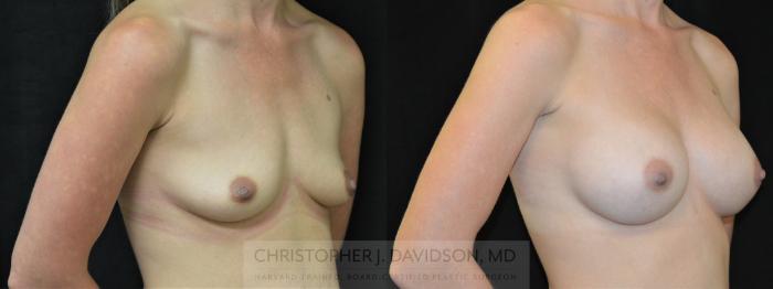 Breast Augmentation Case 293 Before & After Right Oblique | Boston, MA | Christopher J. Davidson, MD