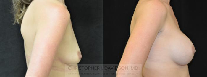 Breast Augmentation Case 293 Before & After Right Side | Boston, MA | Christopher J. Davidson, MD