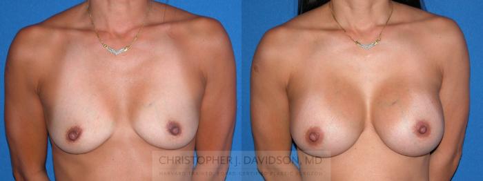 Breast Augmentation Case 3 Before & After View #1 | Boston, MA | Christopher J. Davidson, MD