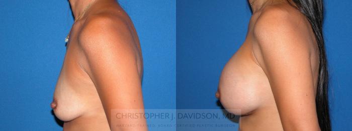 Breast Augmentation Case 3 Before & After View #2 | Boston, MA | Christopher J. Davidson, MD