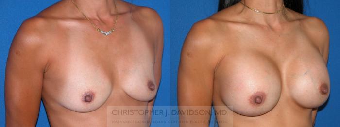 Breast Augmentation Case 3 Before & After View #3 | Boston, MA | Christopher J. Davidson, MD