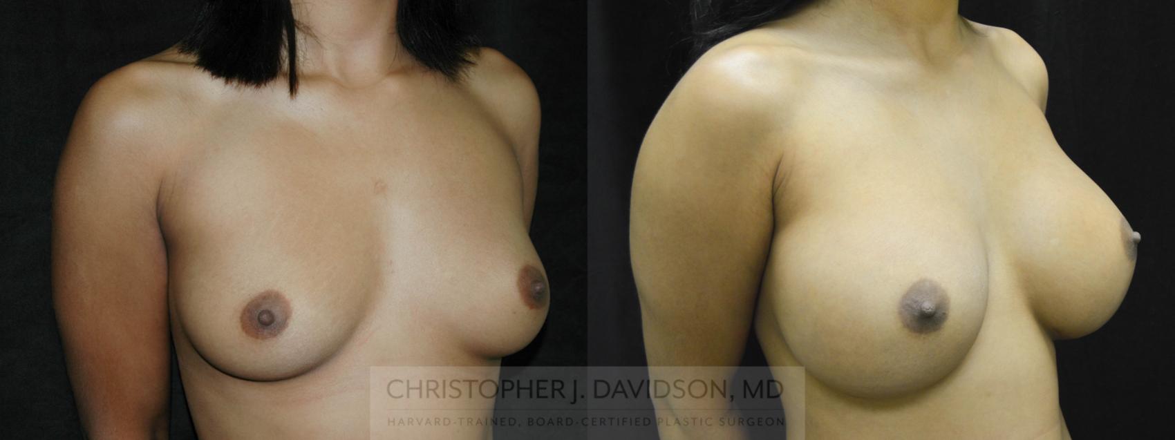 Breast Augmentation Case 30 Before & After View #2 | Wellesley, MA | Christopher J. Davidson, MD