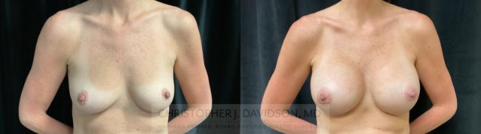 Breast Augmentation Case 303 Before & After Front | Boston, MA | Christopher J. Davidson, MD