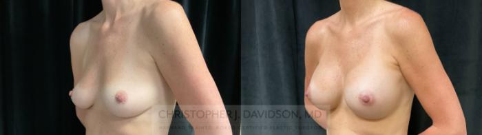 Breast Augmentation Case 303 Before & After Left Oblique | Boston, MA | Christopher J. Davidson, MD