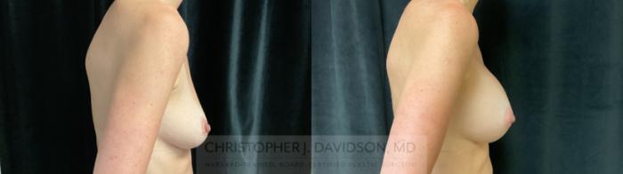 Breast Augmentation Case 303 Before & After Right Side | Boston, MA | Christopher J. Davidson, MD