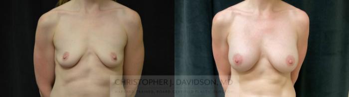 Breast Augmentation Case 304 Before & After Front | Boston, MA | Christopher J. Davidson, MD