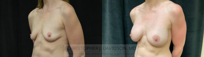 Breast Augmentation Case 304 Before & After Left Oblique | Boston, MA | Christopher J. Davidson, MD