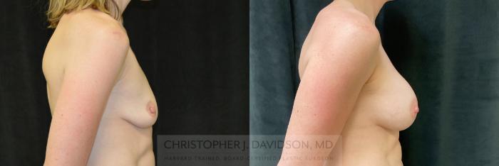 Breast Augmentation Case 304 Before & After Right Side | Boston, MA | Christopher J. Davidson, MD