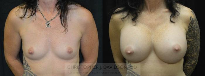Breast Augmentation Case 31 Before & After View #1 | Boston, MA | Christopher J. Davidson, MD
